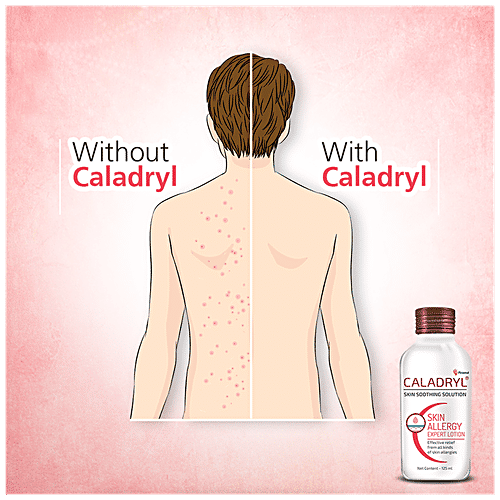 Caladryl Skin Allergy Lotion - Expert Skin Soothing Solution, 65 ml