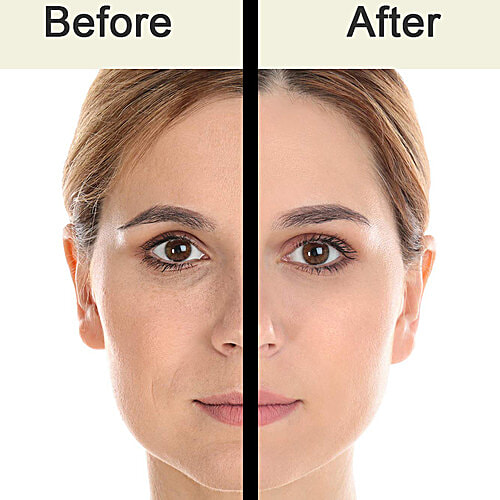 Alloes BWitte Gel Face Wash - Daily Cleansing, Suitable For Oily & Acne Prone Skin, 75 g Tube