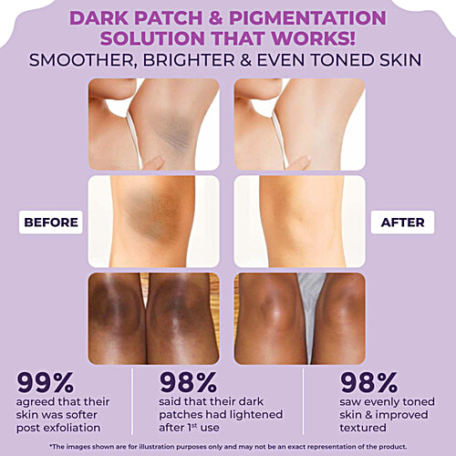 Sanfe Instant Spotlite Mask For Dark Underarm, Neck & Body, 2.5% Kojic Acid & 3.1% Glycolic Acid, 100 g  