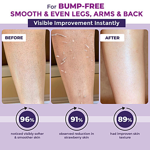 Sanfe Instant Bumps Eraser Exfoliating Gel - For Rough, Bumpy Skin, Tan, Strawberry Legs, 200 g  